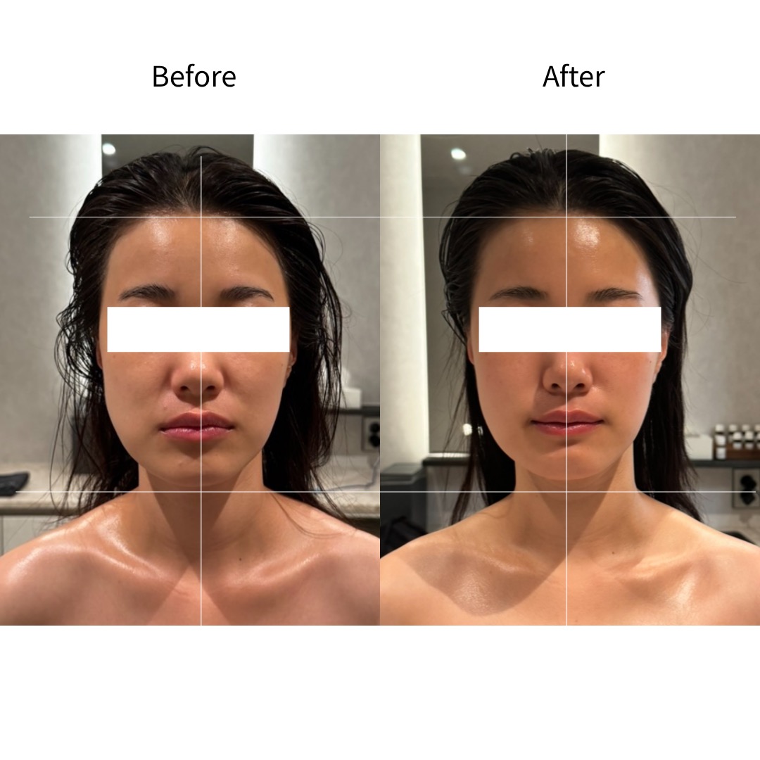 사각턱 얼굴균형 Before & After